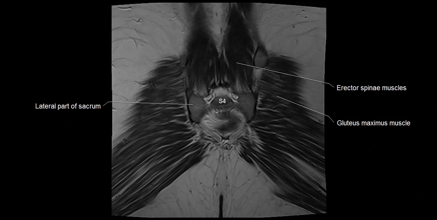 female pelvis coronal cross sectional anatomy image 35.webp